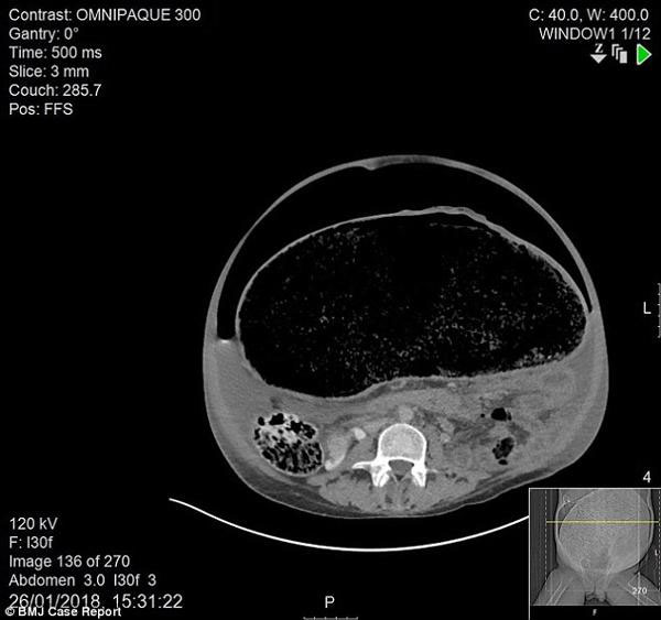 Picture 2 of Abdominal pain, diarrhea for 1 week, the man almost lost his life due to colon