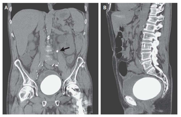 Picture 1 of Abdominal pain, the man hospitalized for X-rays and obtained a frightening result