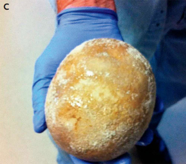 Picture 2 of Abdominal pain, the man hospitalized for X-rays and obtained a frightening result
