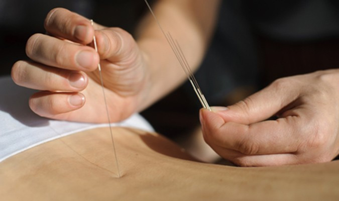 Picture 1 of Acupuncture really 'has an effect' on the human body