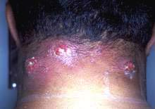 Picture 3 of Acute folliculitis is common during the hot season