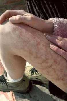 Picture 1 of Add a terrible disease to humans