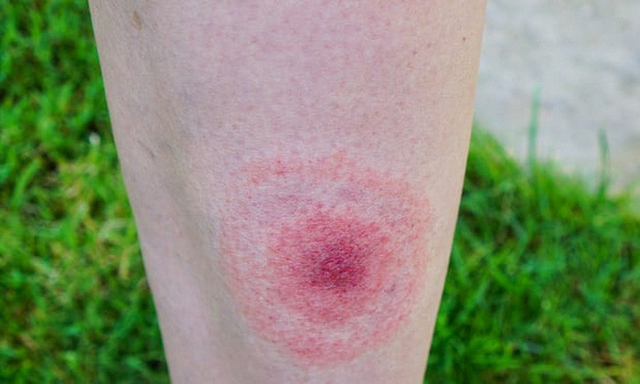 Picture 2 of After SARS, Zika, the 'enemies' of humans are parasitic ticks?