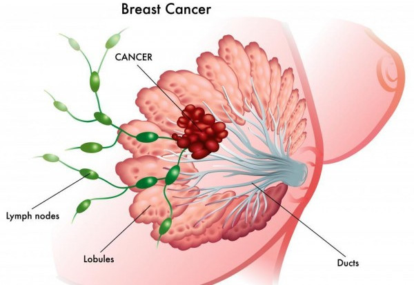 Picture 3 of All you need to know about cancer screening