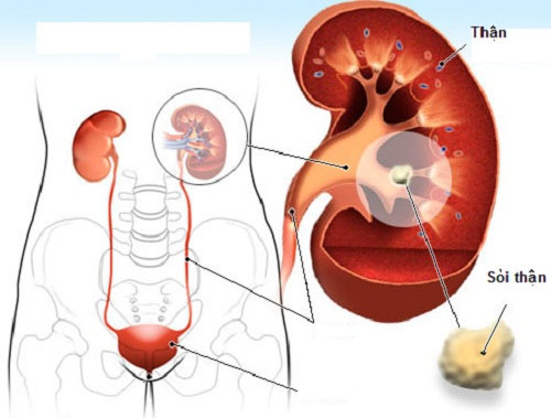 Picture 1 of All you need to know about kidney stones