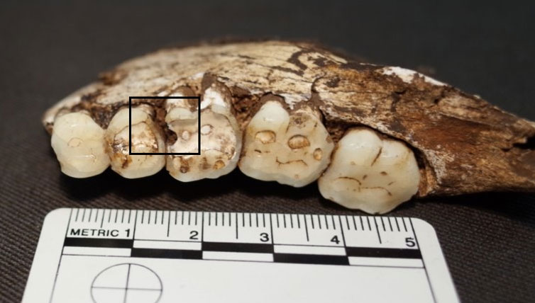 Picture 2 of Although not eating sugar, drinking carbonated water, but the ancient people still have tooth decay?