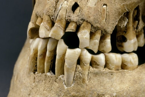 Picture 3 of Although not eating sugar, drinking carbonated water, but the ancient people still have tooth decay?