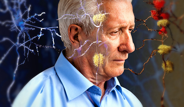Picture 2 of Alzheimer's also has many different types