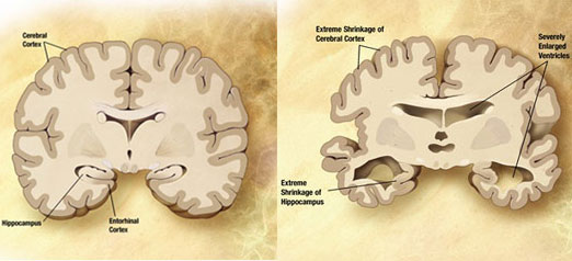 Picture 1 of Alzheimer's disease is preventable