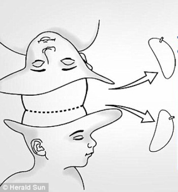 Picture 4 of Amazed at the surgery to separate two conjoined girls
