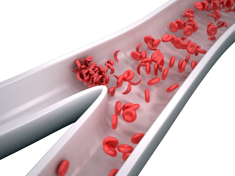 Picture 1 of America develops sickle cell therapy