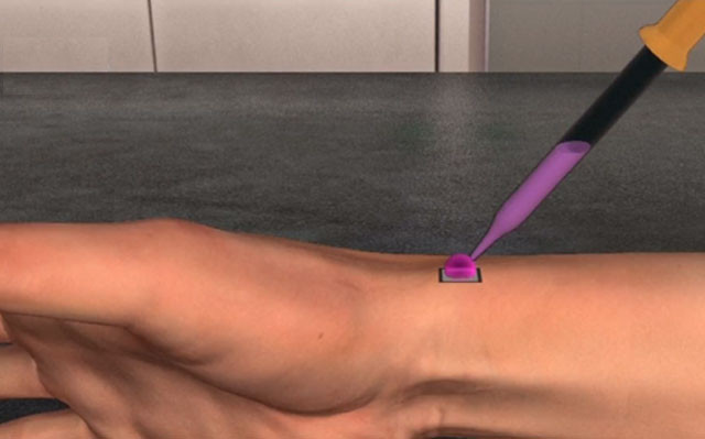 Picture 1 of America develops super chips that help heal wounds