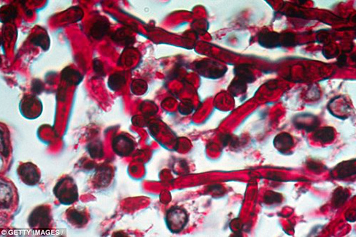 Picture 3 of American doctors are concerned about a new deadly fungal infection strain