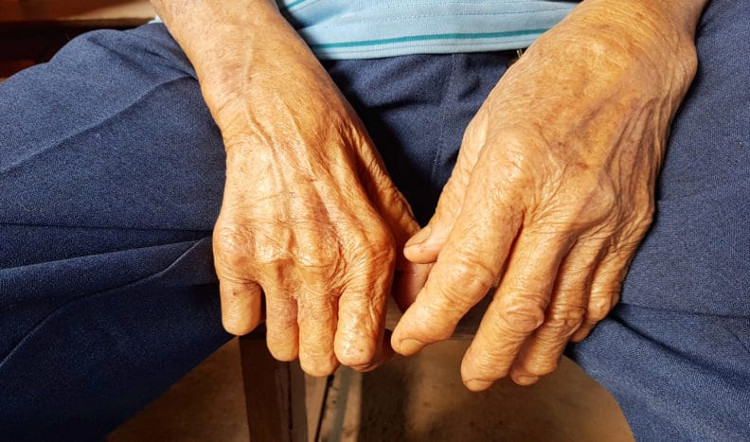 Picture 3 of Ancient bacteria causing leprosy are mutating