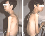 Ankylosing spondylitis images 1