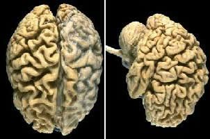 Picture 1 of Anoxic brain due to stroke can lead to Alzheimer's disease