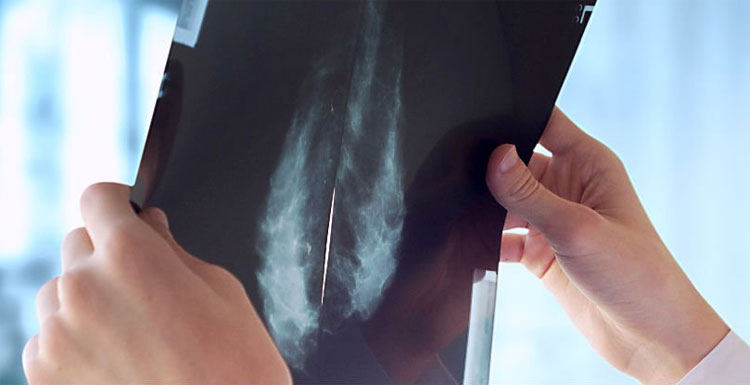 Picture 1 of Anti-osteoporosis drugs can inhibit breast cancer