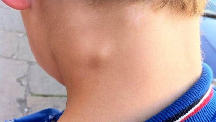 Picture 1 of Are there any symptoms of lymph nodes in the right neck?
