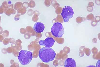 Picture 1 of Art of seduction of leukemia