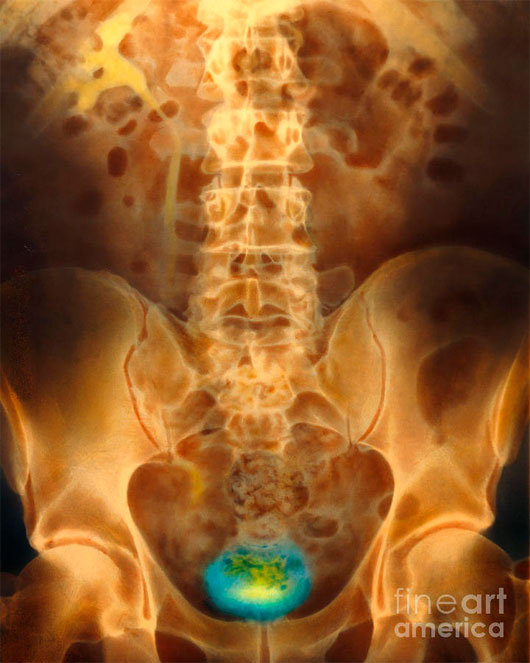 Picture 1 of Artificial bladder