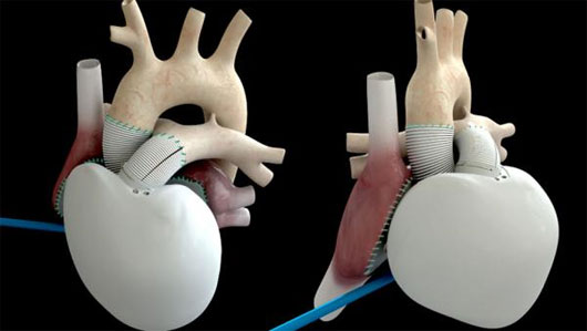 Picture 1 of Artificial heart self-regulating Carmat for the first time implanted