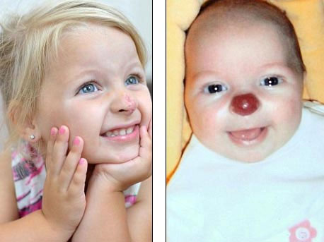 Picture 2 of Baby girl born with circus clown nose
