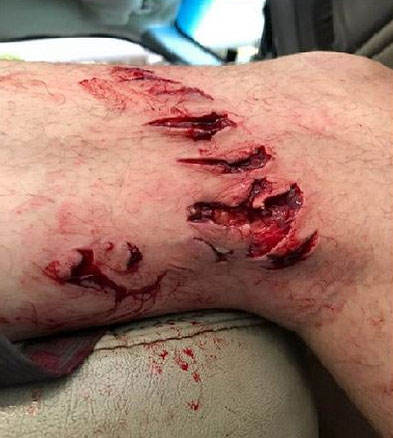 Picture 1 of 'Bacteria eat humans' after being bitten by sharks