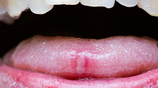 Picture 3 of Bacterial buccal cavity, but why does the bite bite not get infected?