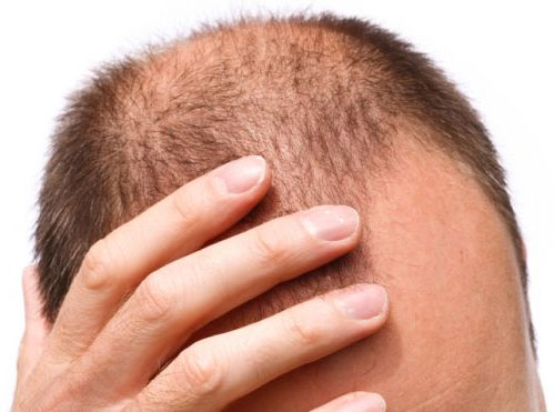 Picture 1 of Baldness medication increases the risk of depression