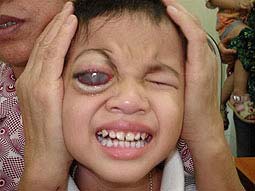 Picture 1 of Be wary of children with retinal cancer