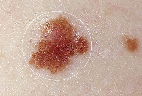 Picture 2 of Beware of mole cancer