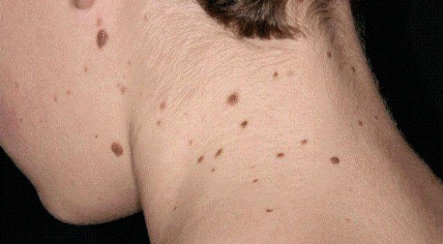 Picture 1 of Black spots appear on the skin, what is the cause?