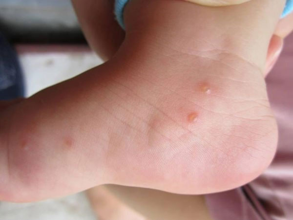 Blisters Around The Body Causes Symptoms And Treatment