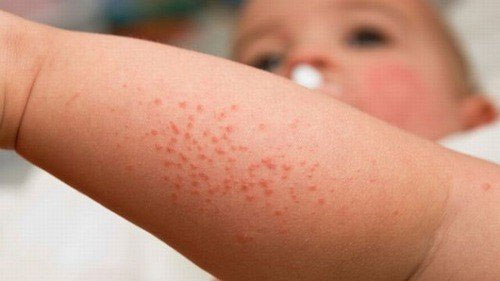 Picture 2 of Blisters around the body: Causes, symptoms and treatment