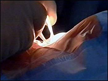 Picture 2 of Blurred vision, cured by gene transfer