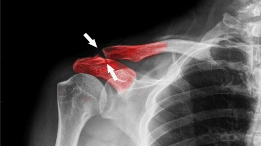 Picture 1 of Bone regeneration with magnetic nanoparticles