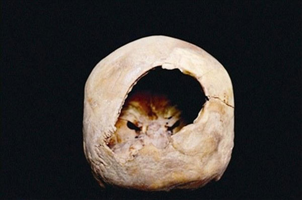 Picture 1 of Brain surgery can take place 3,000 years ago