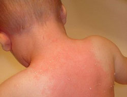 Picture 1 of Breakthrough in the treatment of Kawasaki disease