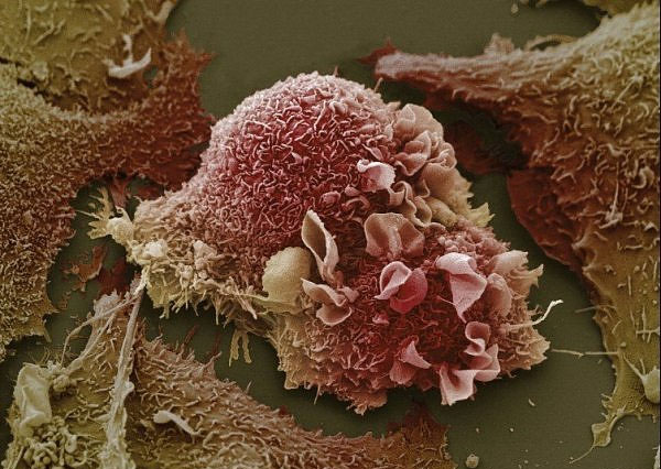 Picture 1 of Breast cancer cells can resist the immune system