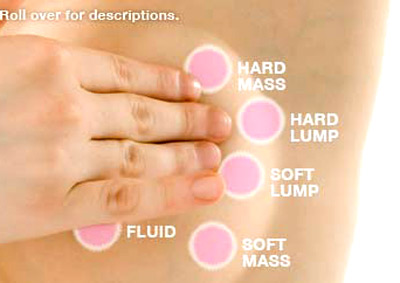 Picture 1 of Breast cancer is not necessarily cancer