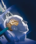 Picture 1 of Burning laser brain tumors