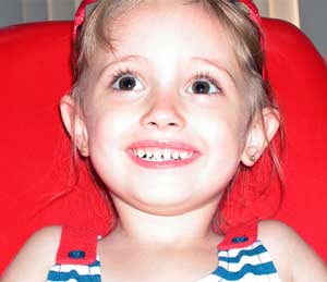 Picture 1 of Caesarean section, increase the risk of tooth decay in children