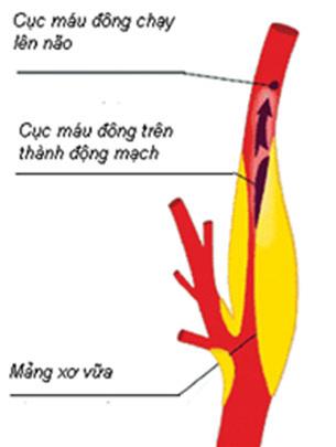 Picture 2 of Carotid artery stenosis - one of the causes of stroke