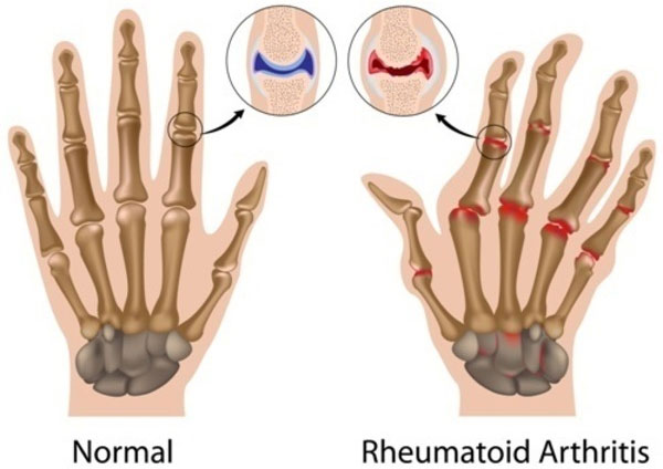 Causes and risk factors of rheumatoid arthritis (Part 1)