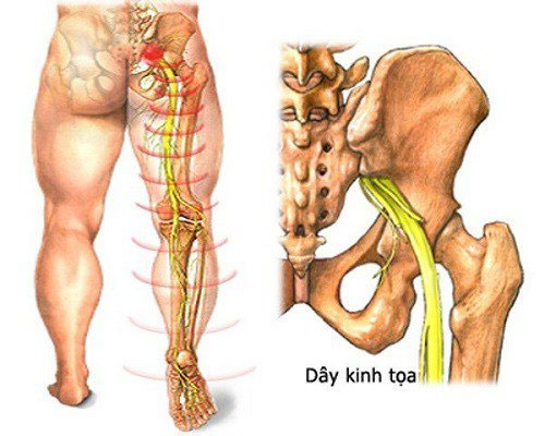 Picture 1 of Causes and treatment of sciatica