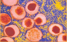 Cell therapy helps diabetics not need insulin injections images 1