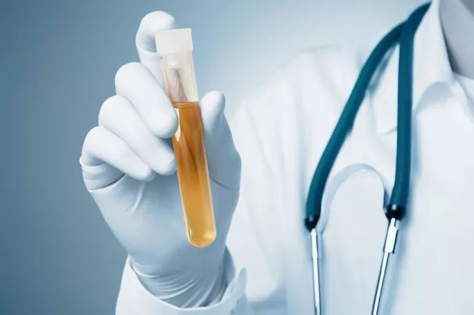 Picture 1 of Change urine color, detect 1 type of cancer very accurately