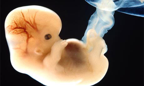 Picture 2 of Childbirth with sister's ovaries