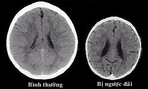 Picture 1 of Children with abusive parents are more prone to brain atrophy