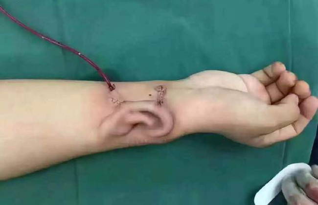 Picture 1 of Chinese doctor implants the ear in the patient's hand